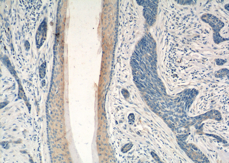 Immunohistochemistry of paraffin-embedded human skin cancer tissue slide using Catalog No:113766(PDCD5 Antibody) at dilution of 1:50 (under 10x lens)