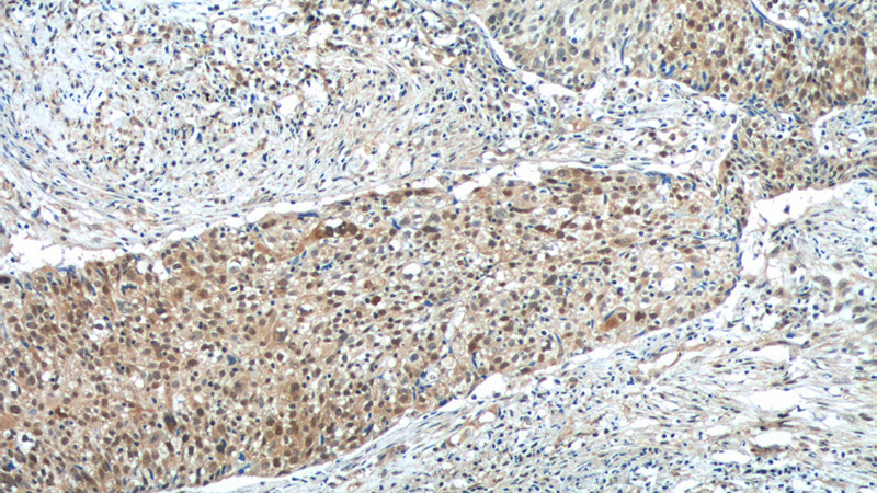 Immunohistochemistry of paraffin-embedded human lung cancer tissue slide using Catalog No:113289(NSFL1C Antibody) at dilution of 1:50 (under 10x lens)