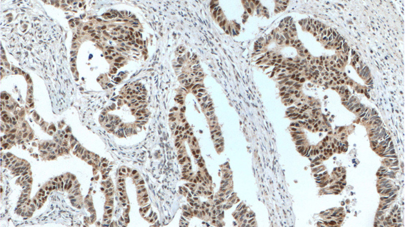 Immunohistochemistry of paraffin-embedded human colon cancer tissue slide using Catalog No:107431(MSH6 Antibody) at dilution of 1:800 (under 10x lens). heat mediated antigen retrieved with Tris-EDTA buffer(pH9).