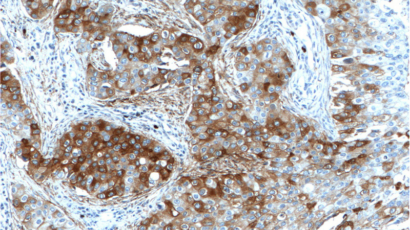 Immunohistochemistry of paraffin-embedded human breast cancer tissue slide using Catalog No:110747(FUT4 Antibody) at dilution of 1:200 (under 10x lens).