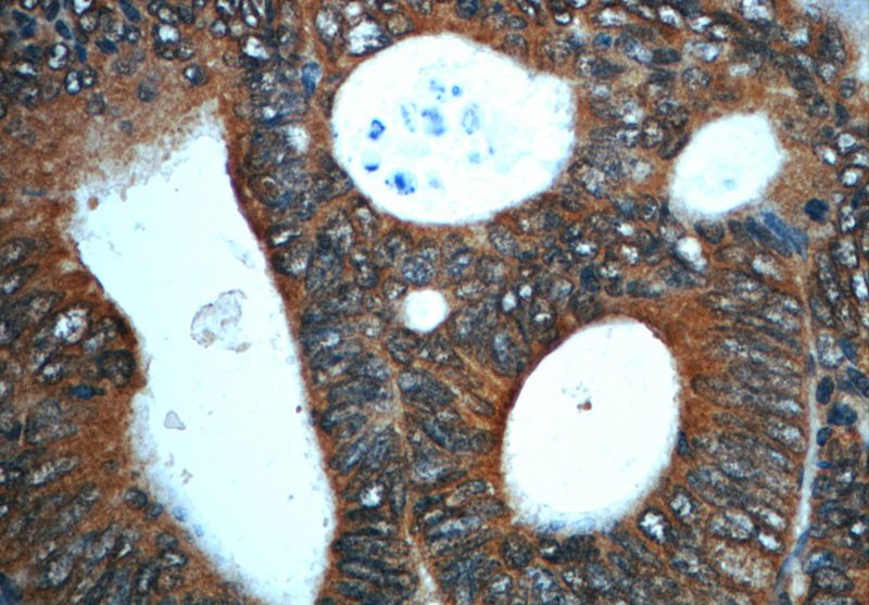 Immunohistochemistry of paraffin-embedded human colon cancer slide using Catalog No:113844(PRKACA Antibody) at dilution of 1:50