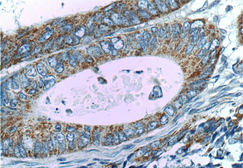 Immunohistochemistry of paraffin-embedded human colon cancer tissue slide using Catalog No:110449(FADS1 Antibody) at dilution of 1:200 (under 40x lens)