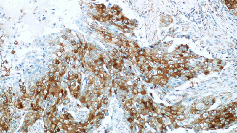 Immunohistochemistry of paraffin-embedded human breast cancer tissue slide using Catalog No:114787(ROR1 Antibody) at dilution of 1:50 (under 10x lens)