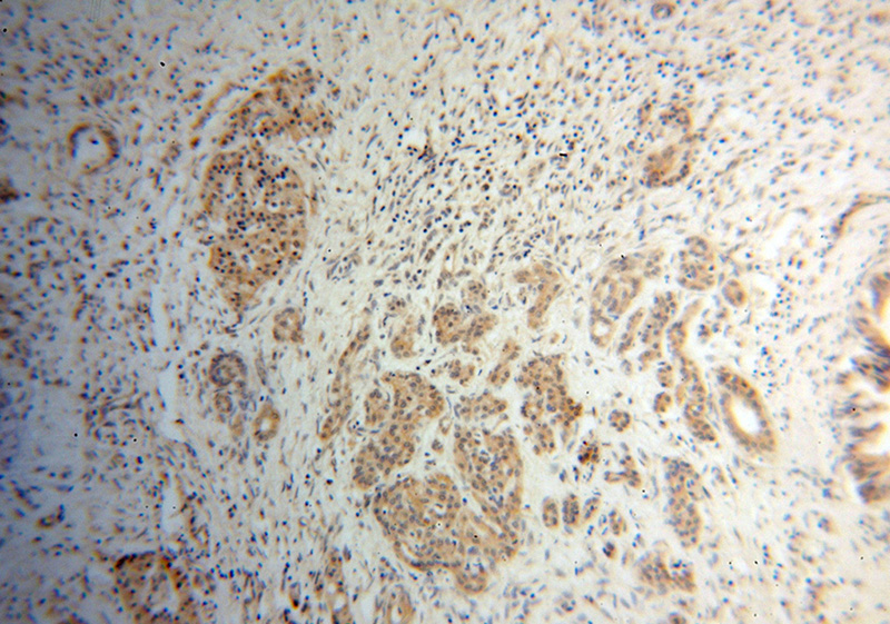 Immunohistochemical of paraffin-embedded human pancreas cancer using Catalog No:108019(ANAPC5 antibody) at dilution of 1:50 (under 10x lens)