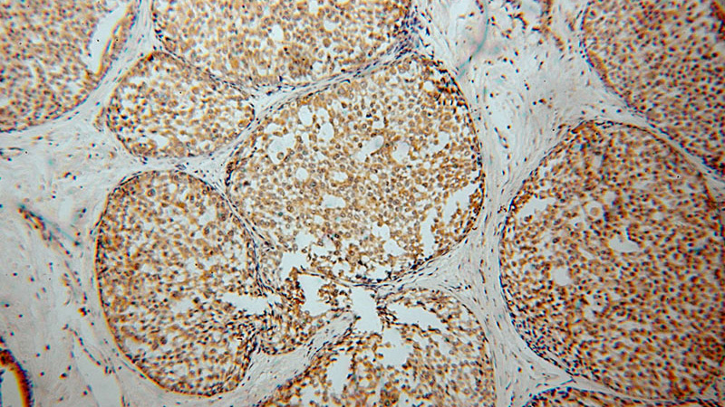Immunohistochemical of paraffin-embedded human breast cancer using Catalog No:116596(USP2 antibody) at dilution of 1:50 (under 10x lens)