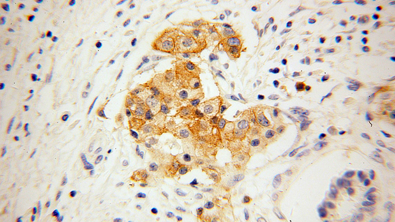 Immunohistochemical of paraffin-embedded human pancreas cancer using Catalog No:111002(GNG4 antibody) at dilution of 1:100 (under 40x lens)
