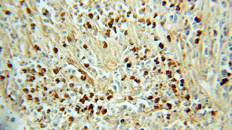 Immunohistochemical of paraffin-embedded human prostate cancer using Catalog No:111208(GRIM19 antibody) at dilution of 1:50 (under 10x lens)