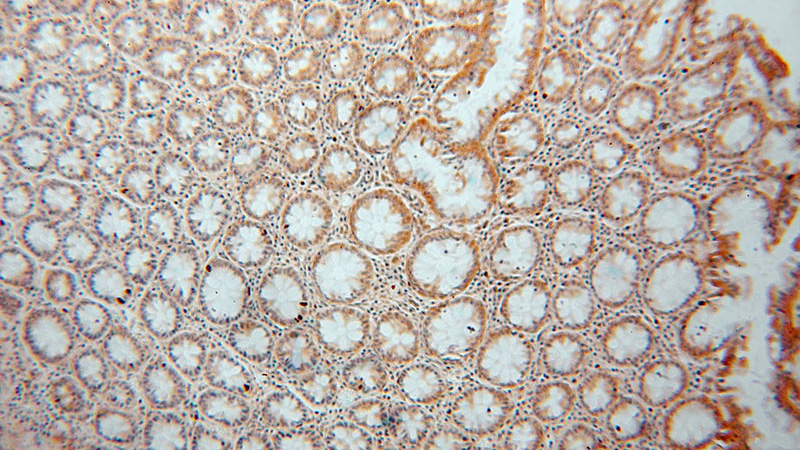 Immunohistochemical of paraffin-embedded human colon cancer using Catalog No:109769(DDAH2 antibody) at dilution of 1:50 (under 10x lens)