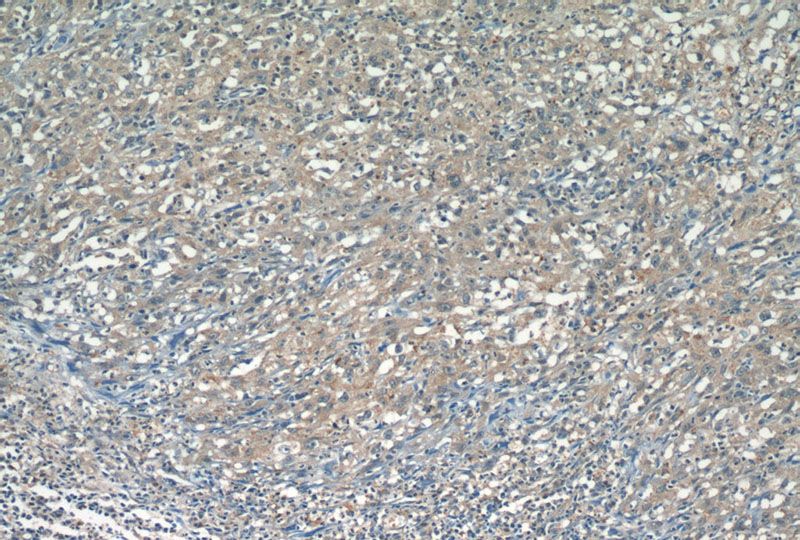 Immunohistochemistry of paraffin-embedded human cervical cancer tissue slide using Catalog No:111890(JNK Antibody) at dilution of 1:50 (under 10x lens)