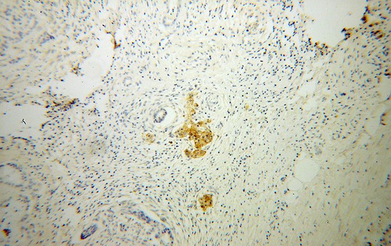 Immunohistochemical of paraffin-embedded human pancreas cancer using Catalog No:111002(GNG4 antibody) at dilution of 1:100 (under 10x lens)