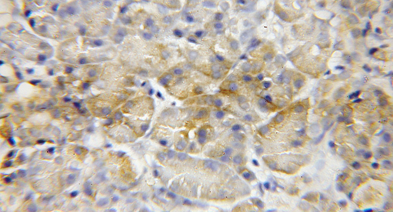 Immunohistochemical of paraffin-embedded human pancreas cancer using Catalog No:112544(MCCC2 antibody) at dilution of 1:50 (under 10x lens)