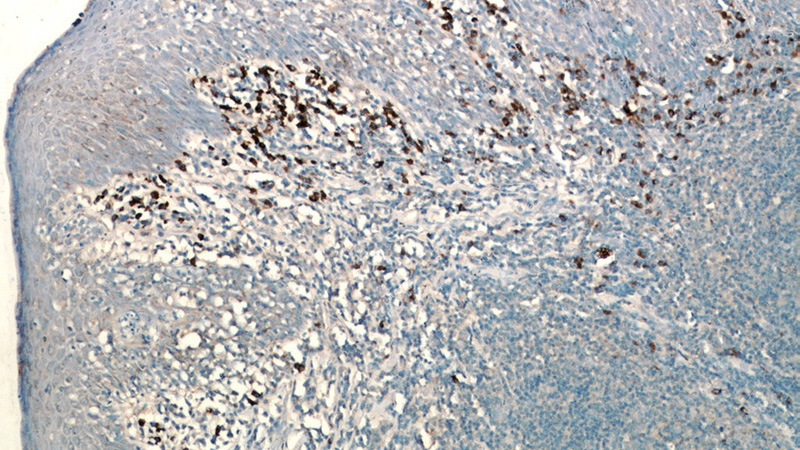 Immunohistochemical of paraffin-embedded human tonsil using Catalog No:107043(SDC1,CD138 antibody) at dilution of 1:50 (under 10x lens)