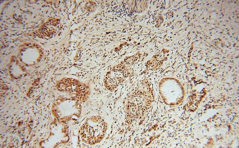 Immunohistochemical of paraffin-embedded human pancreas cancer using Catalog No:113437(OSGEP antibody) at dilution of 1:50 (under 10x lens)