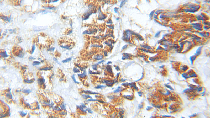 Immunohistochemical of paraffin-embedded human prostate cancer using Catalog No:112542(MCC antibody) at dilution of 1:100 (under 10x lens)