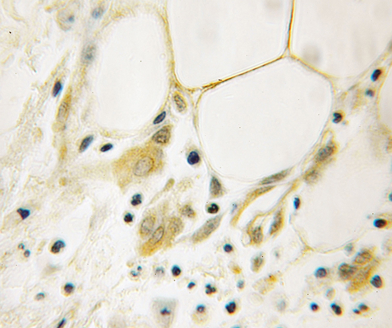 Immunohistochemical of paraffin-embedded human breast cancer using Catalog No:107826(AGFG1 antibody) at dilution of 1:100 (under 10x lens)