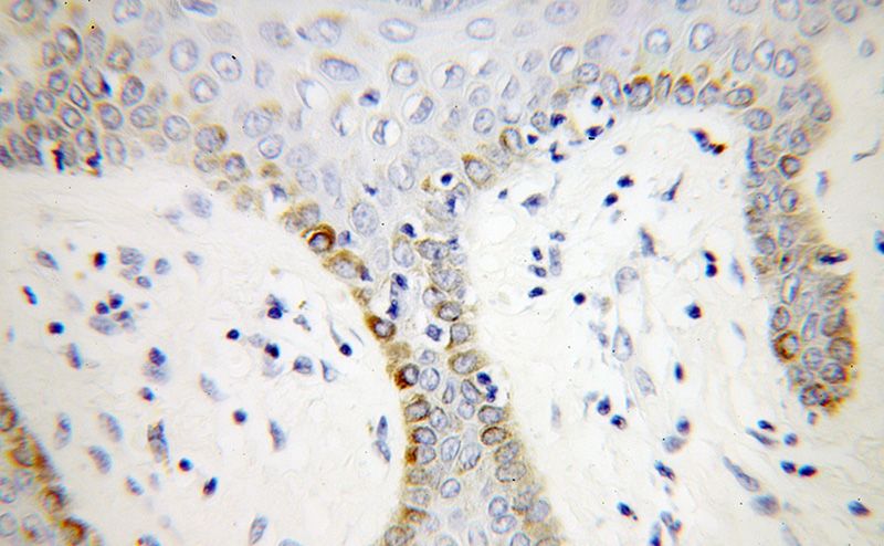 Immunohistochemical of paraffin-embedded human skin cancer using Catalog No:112875(MSRA antibody) at dilution of 1:50 (under 40x lens)