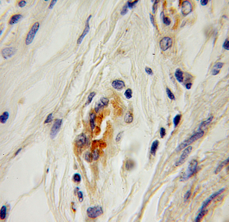 Immunohistochemical of paraffin-embedded human cervical cancer using Catalog No:115120(SEPT6 antibody) at dilution of 1:100 (under 10x lens)