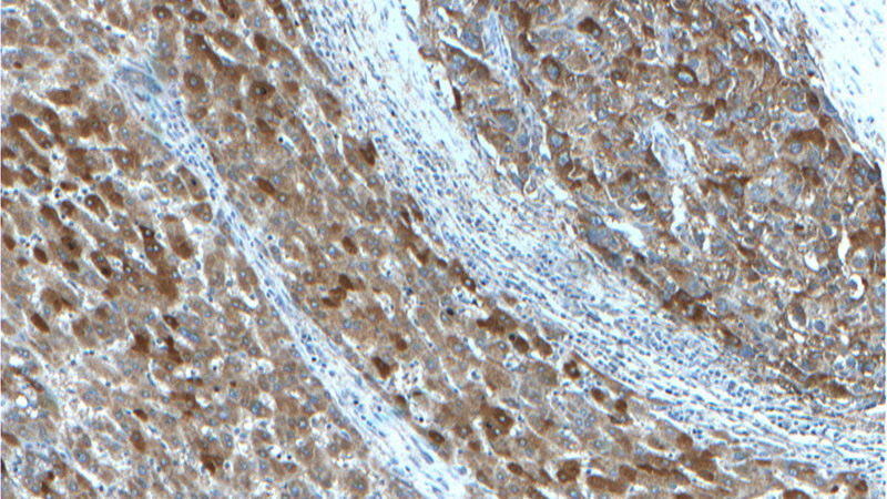 Immunohistochemistry of paraffin-embedded human liver cancer tissue slide using Catalog No:110602(FAM84B Antibody) at dilution of 1:200 (under 10x lens).
