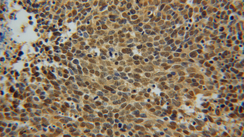 Immunohistochemical of paraffin-embedded human lung cancer using Catalog No:116511(UBE2I-Specific antibody) at dilution of 1:50 (under 40x lens)