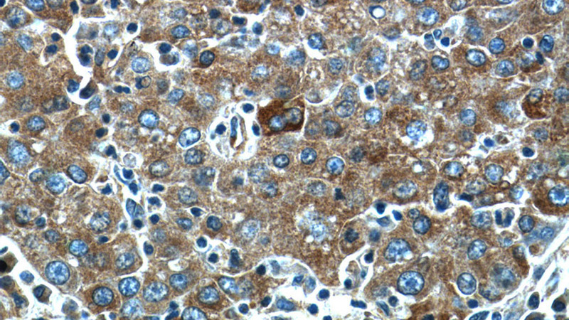 Immunohistochemistry of paraffin-embedded human liver cancer tissue slide using Catalog No:113272(NRBF2 Antibody) at dilution of 1:50 (under 40x lens)
