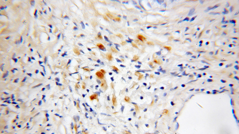 Immunohistochemical of paraffin-embedded human prostate cancer using Catalog No:111673(IFT81 antibody) at dilution of 1:50 (under 10x lens)
