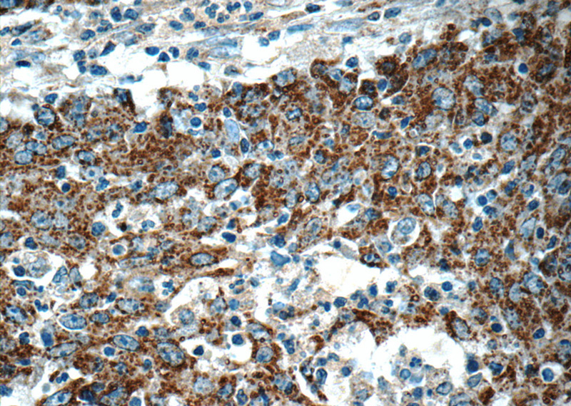 Immunohistochemistry of paraffin-embedded human colon cancer tissue slide using Catalog No:108854(CARD11 Antibody) at dilution of 1:50 (under 40x lens)