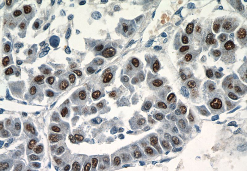 Immunohistochemistry of paraffin-embedded human liver cancer tissue slide using Catalog No:115165(CCDC101 Antibody) at dilution of 1:400 (under 40x lens)