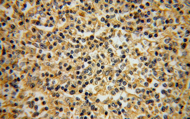 Immunohistochemical of paraffin-embedded human lymphoma using Catalog No:115310(SLC20A1 antibody) at dilution of 1:50 (under 40x lens)