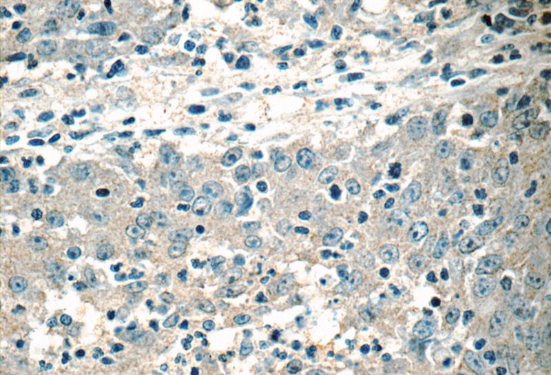 Immunohistochemistry of paraffin-embedded human colon cancer tissue slide using Catalog No:111541(HSCB Antibody) at dilution of 1:50 (under 40x lens)
