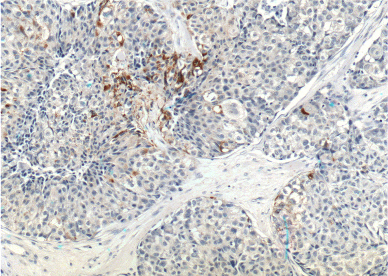 Immunohistochemistry of paraffin-embedded human lung cancer tissue slide using Catalog No:114852(RSPO3 Antibody) at dilution of 1:200 (under 10x lens).