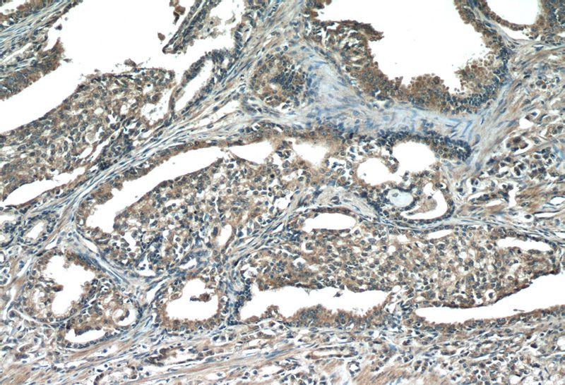 Immunohistochemistry of paraffin-embedded human prostate cancer tissue slide using Catalog No:116089(TMEFF2 Antibody) at dilution of 1:100 (under 10x lens)