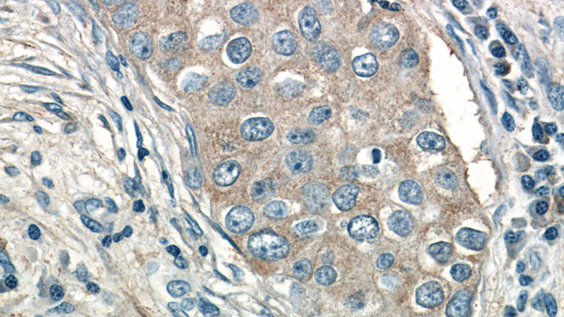 Immunohistochemistry of paraffin-embedded human breast cancer tissue slide using Catalog No:109241(CHKA-Specific Antibody) at dilution of 1:50(under 40x lens)