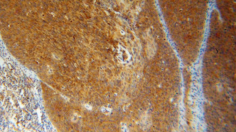 Immunohistochemical of paraffin-embedded human cervical cancer using Catalog No:109475(CORO1C antibody) at dilution of 1:100 (under 10x lens)