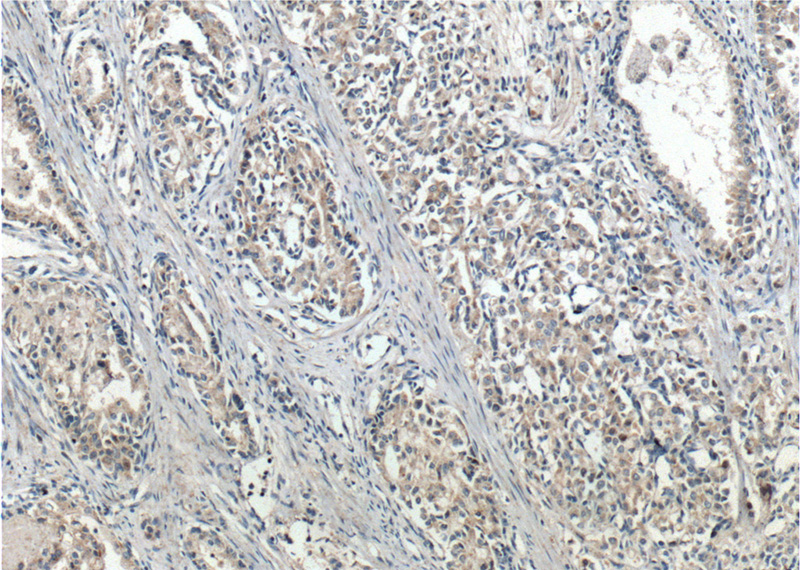 Immunohistochemistry of paraffin-embedded human prostate cancer tissue slide using Catalog No:114264(PTEN Antibody) at dilution of 1:200 (under 10x lens). heat mediated antigen retrieved with Tris-EDTA buffer(pH9).