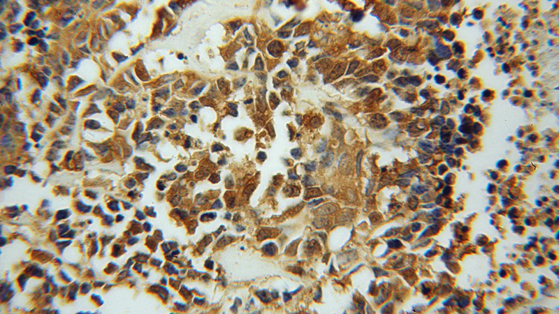 Immunohistochemical of paraffin-embedded human lung cancer using Catalog No:108233(ASNA1 antibody) at dilution of 1:50 (under 40x lens)