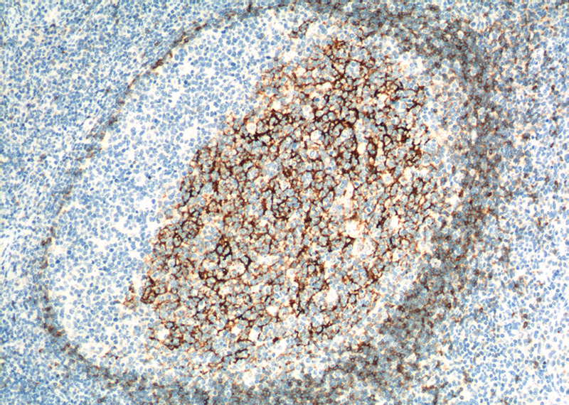 Immunohistochemistry of paraffin-embedded human tonsillitis tissue slide using Catalog No:107126(CD23,FCER2 Antibody) at dilution of 1:200 (under 10x lens). heat mediated antigen retrieved with Tris-EDTA buffer(pH9).