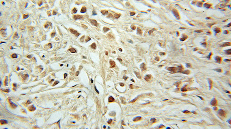 Immunohistochemical of paraffin-embedded human prostate cancer using Catalog No:114489(RB1 antibody) at dilution of 1:200 (under 10x lens)