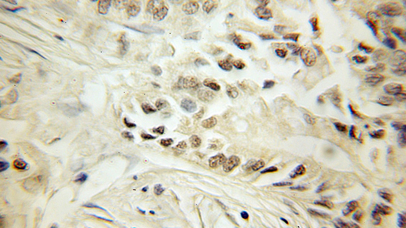 Immunohistochemical of paraffin-embedded human pancreas cancer using Catalog No:115139(SF3B4 antibody) at dilution of 1:50 (under 10x lens)