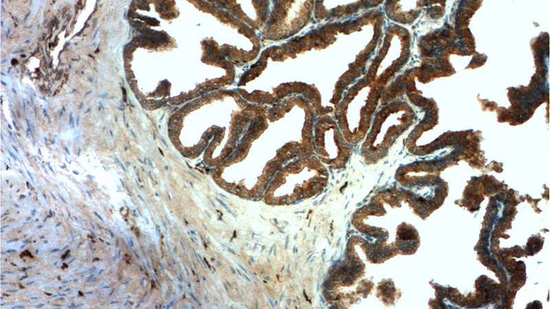 Immunohistochemistry of paraffin-embedded human prostate cancer tissue slide using Catalog No:114290(PSAP Antibody) at dilution of 1:50 (under 10x lens)