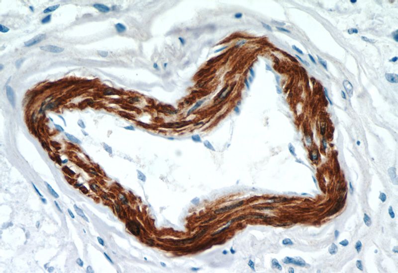 Immunohistochemistry of paraffin-embedded human breast cancer tissue slide using Catalog No:110551(FBXO28 Antibody) at dilution of 1:50 (under 40x lens)
