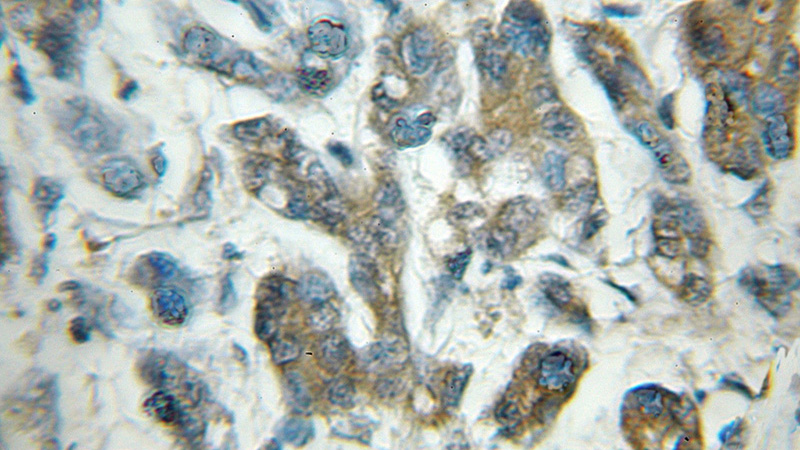 Immunohistochemical of paraffin-embedded human pancreas cancer using Catalog No:110266(EIF5 antibody) at dilution of 1:50 (under 10x lens)