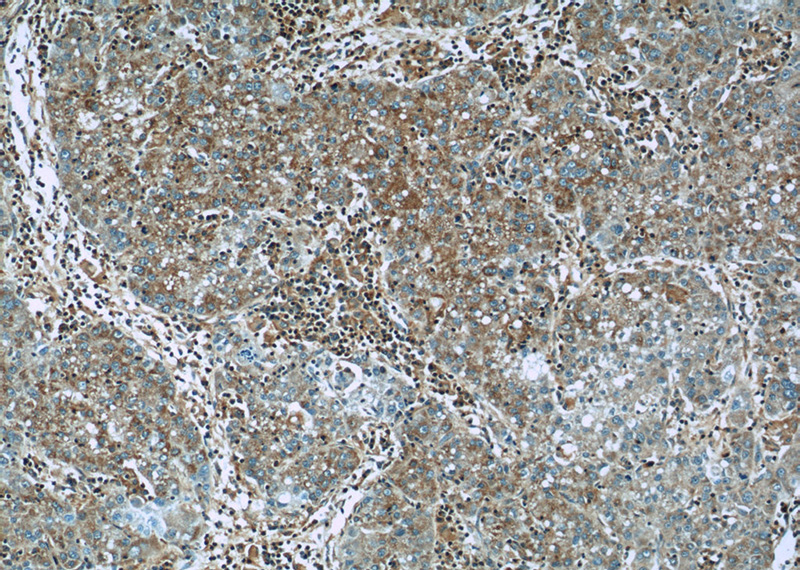 Immunohistochemistry of paraffin-embedded human liver cancer slide using Catalog No:111682(IGF2R-Specific Antibody) at dilution of 1:50