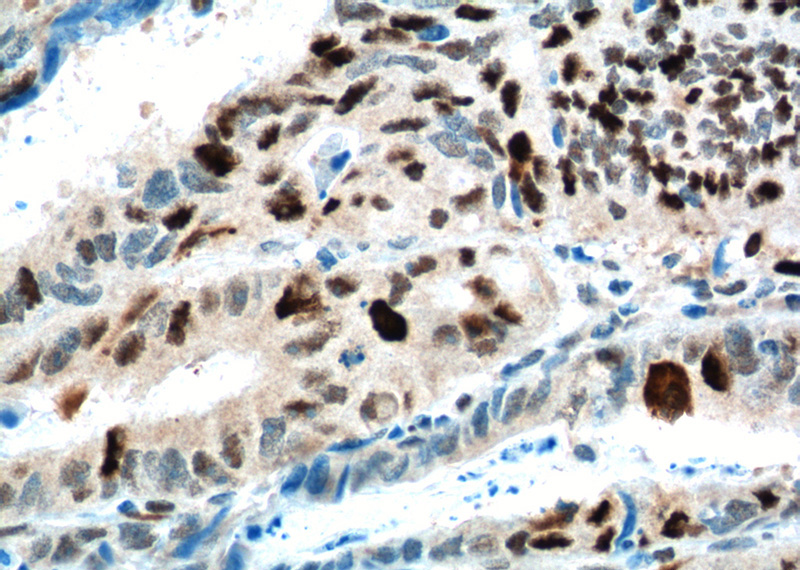 Immunohistochemistry of paraffin-embedded human colon cancer tissue slide using Catalog No:112113(KPNA2 Antibody) at dilution of 1:200 (under 40x lens). heat mediated antigen retrieved with Tris-EDTA buffer(pH9).