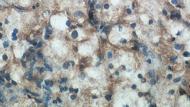 Immunohistochemical of paraffin-embedded human renal cell carcinoma using Catalog No:117251(ZNF839 antibody) at dilution of 1:50 (under 40x lens)