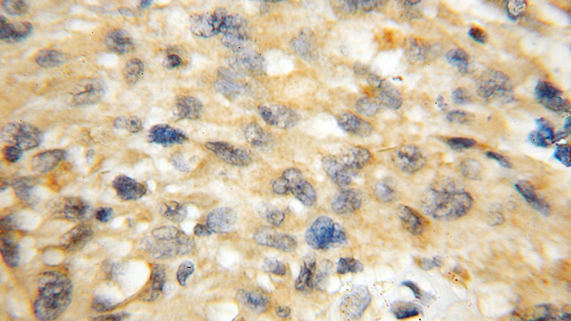 Immunohistochemical of paraffin-embedded human gliomas using Catalog No:108389(BCL11A antibody) at dilution of 1:50 (under 10x lens)