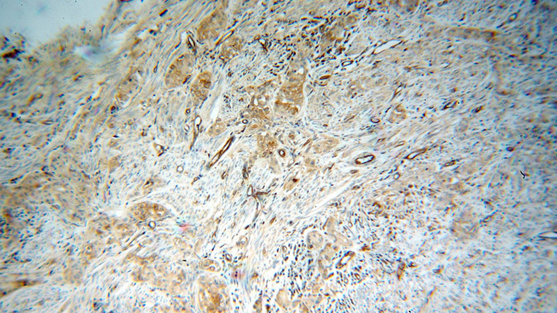 Immunohistochemical of paraffin-embedded human endometrial cancer using Catalog No:111463(HRH1 antibody) at dilution of 1:100 (under 10x lens)