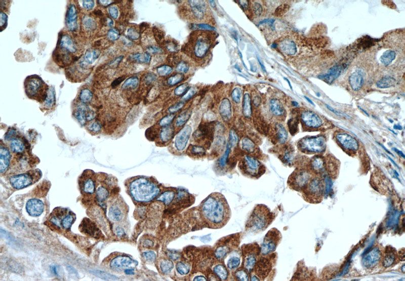Immunohistochemical of paraffin-embedded human lung cancer using Catalog No:107321(NAPSA antibody) at dilution of 1:50 (under 40x lens)