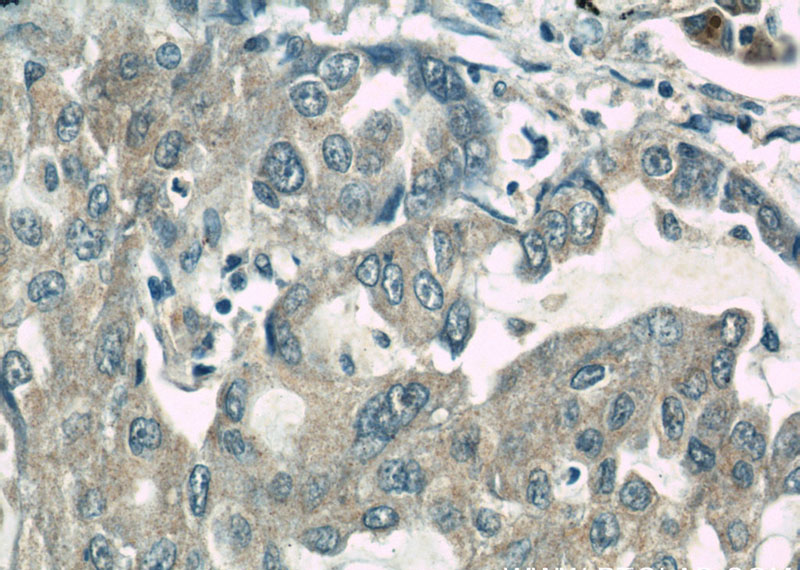 Immunohistochemical of paraffin-embedded human lung cancer using Catalog No:114777(RocK1 antibody) at dilution of 1:50 (under 40x lens)