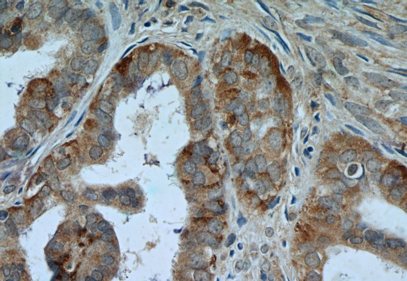 Immunohistochemistry of paraffin-embedded human ovary tumor tissue slide using Catalog No:107181(CTAGE1 Antibody) at dilution of 1:50 (under 40x lens)