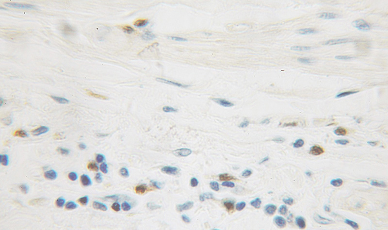 Immunohistochemical of paraffin-embedded human colon cancer using Catalog No:111642(NFKBIB antibody) at dilution of 1:100 (under 10x lens)